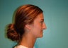 Rhinoplasty- Nose Job