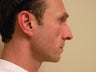 Rhinoplasty 