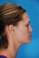 Rhinoplasty (nose job)