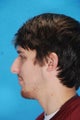 Rhinoplasty (nose job)