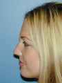 Rhinoplasty
