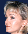 rhinoplasty
