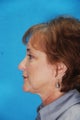 Rhinoplasty (nose job)