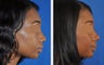 African American Rhinoplasty