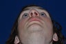 Closed Nasal Reduction (Resetting Broken Nose)