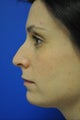 Nose surgery/Rhinoplasty