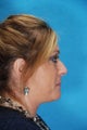 Rhinoplasty (nose job)