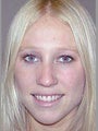 Rhinoplasty