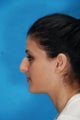 Rhinoplasty (nose job)