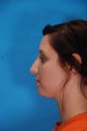 Rhinoplasty (nose job)