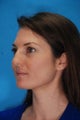 Rhinoplasty (nose job)