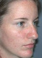 Rhinoplasty