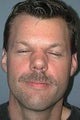 Nose Surgery, Rhinoplasty