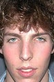 Nose Surgery, Rhinoplasty