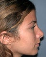Nose Surgery, Rhinoplasty