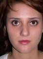 Nose Surgery, Rhinoplasty