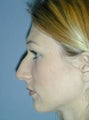 Rhinoplasty