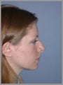 Nose Surgery, Rhinoplasty