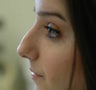 Nose Surgery
