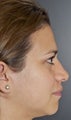 Nose Surgery