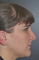 Rhinoplasty
