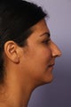 Nose Surgery