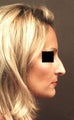 Rhinoplasty
