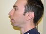Rhinoplasty