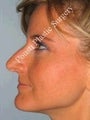 Rhinoplasty 