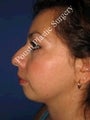 Nose Surgery 