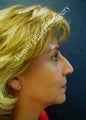 Rhinoplasty 