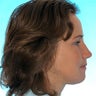 Orthognathic Jaw Surgery