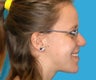 Orthognathic Jaw Surgery