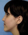Orthognathic Jaw Surgery, Setback of Lower Jaw