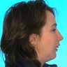 Orthognathic Jaw Surgery