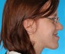 Orthognathic Jaw Surgery