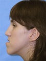 Orthognathic Jaw Surgery, Setback of Lower Jaw
