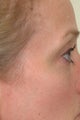 Pearl Laser Treatment