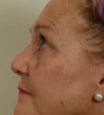 Pearl Laser Treatment