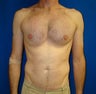 Pectoral Augmentation Surgery