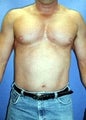 Pectoral Implants