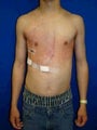 Pectus Excavatum, Chest Wall Reconstruction Surgery