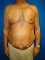 Pectus Excavatum, Chest Wall Reconstruction Surgery