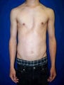 Pectus Excavatum, Chest Wall Reconstruction Surgery