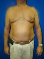 Pectus Excavatum, Chest Wall Reconstruction Surgery