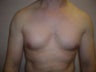 Pec Implants