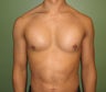 Pectoral Implants