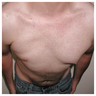 Chest implant for patient with Poland’s syndrome
