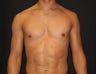 Pectoral Implants