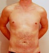 Male Chest Enhancement